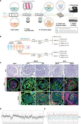 Digital Spatial Profiling of Individual Glomeruli From Patients With Anti-Neutrophil Cytoplasmic Autoantibody-Associated Glomerulonephritis